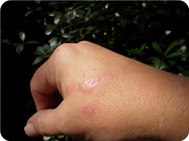 Honey for Burns
